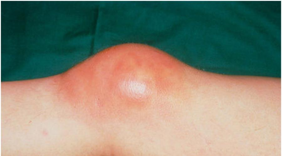 artrita reumatoidă este o articulație infecții ale durerii articulare