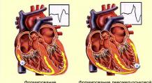 Toate faptele despre extrasistola cardiacă: ce este și cum să o tratăm