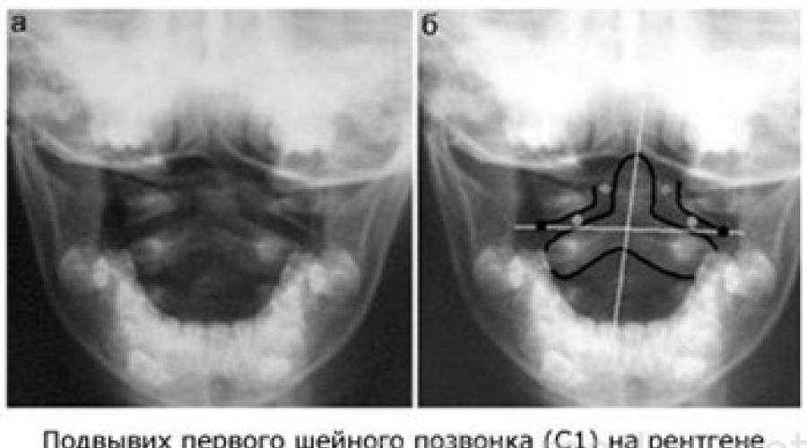 Подвывих. Ротационный подвывих Атланта. Ротационный подвывих Атланта рентген. Ротационный подвывих c1.